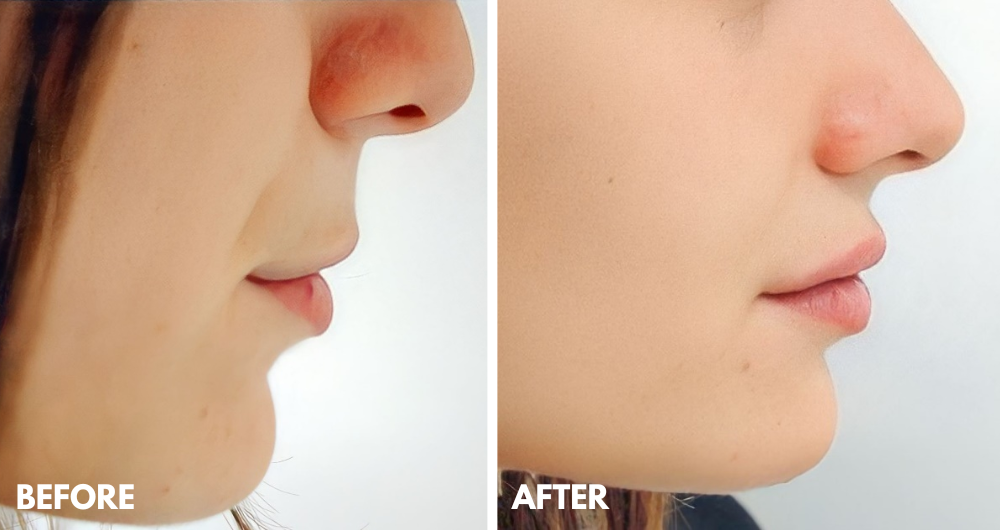 Χείλη Θεραπείες