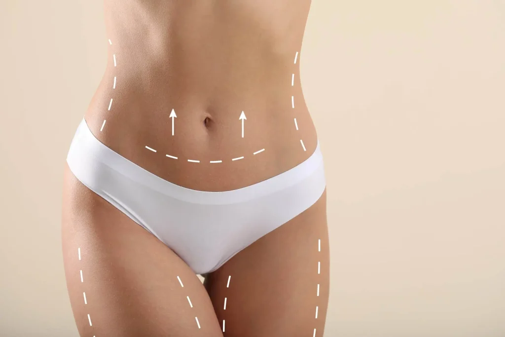 Λιποαναρρόφηση (Λιπογλυπτική)