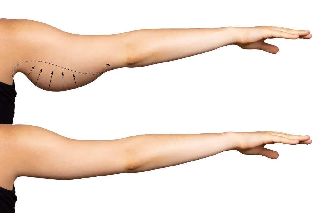 Βραχιονοπλαστική