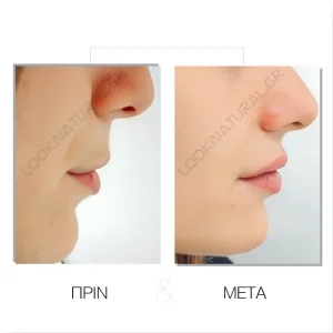 Λιπομεταφορά - Πριν & Μετά