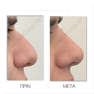 Υγρή Ρινοπλαστική - Πριν & Μετά