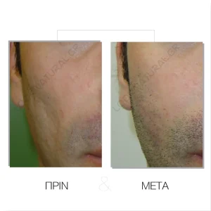 Λιπομεταφορά - Πριν & Μετά