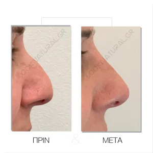 Υγρή Ρινοπλαστική - Πριν & Μετά