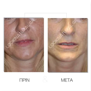 Λιπομεταφορά - Πριν & Μετά