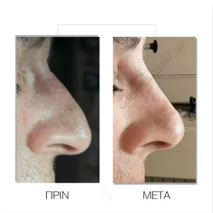 Υγρή Ρινοπλαστική - Πριν & Μετά