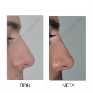 Υγρή Ρινοπλαστική - Πριν & Μετά