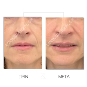 Λιπομεταφορά - Πριν & Μετά