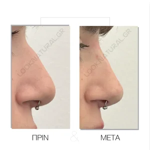 Υγρή Ρινοπλαστική - Πριν & Μετά