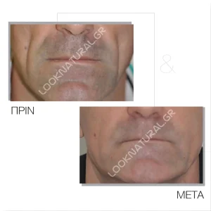 Λιπομεταφορά - Πριν & Μετά