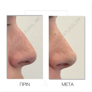 Υγρή Ρινοπλαστική - Πριν & Μετά