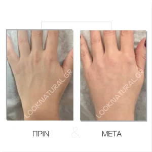 Λιπομεταφορά - Πριν & Μετά