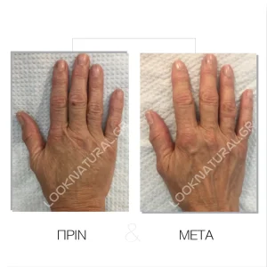 Λιπομεταφορά - Πριν & Μετά