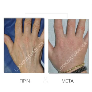 Λιπομεταφορά - Πριν & Μετά