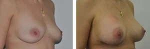 Πριν & Μετά - Αυξηση Μαστων