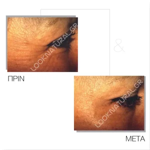 Πριν & Μετά - Βουτουλινική Τοξίνη