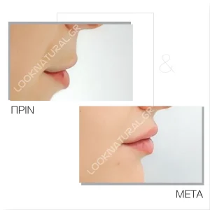 Πριν & Μετά - Αυξητική Χειλιών