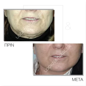 Πριν & Μετά - Facelift