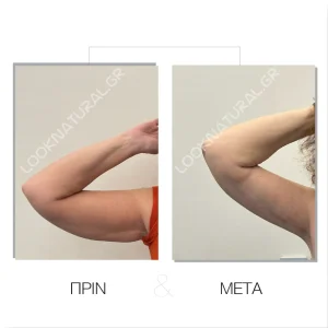 Πριν & Μετά - Βραχιονοπλαστική