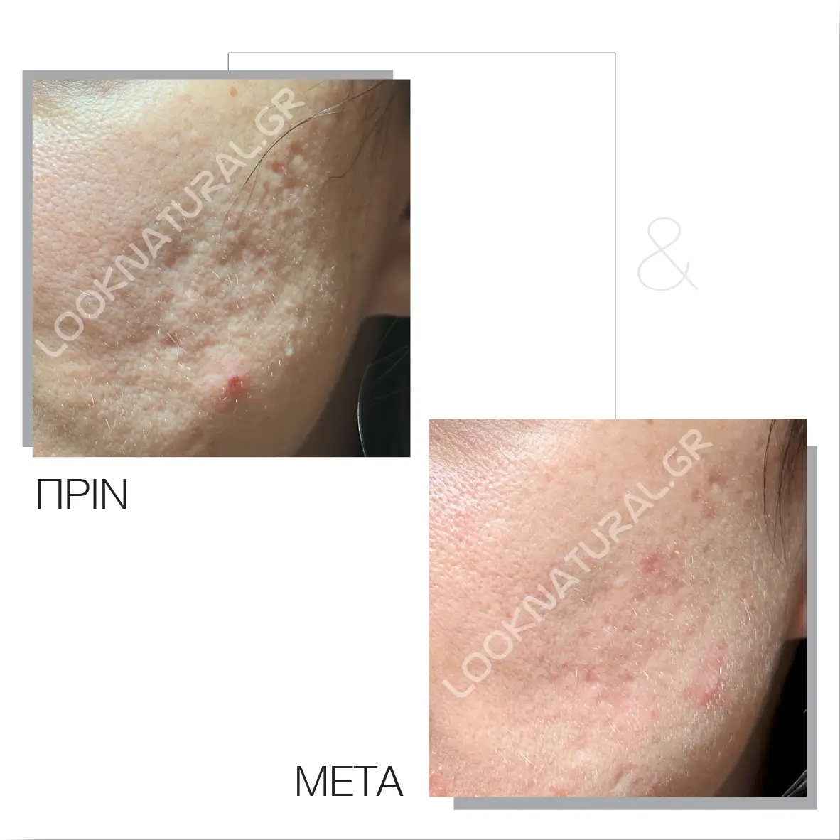 Πριν & Μετά - Ουλές Ακμής