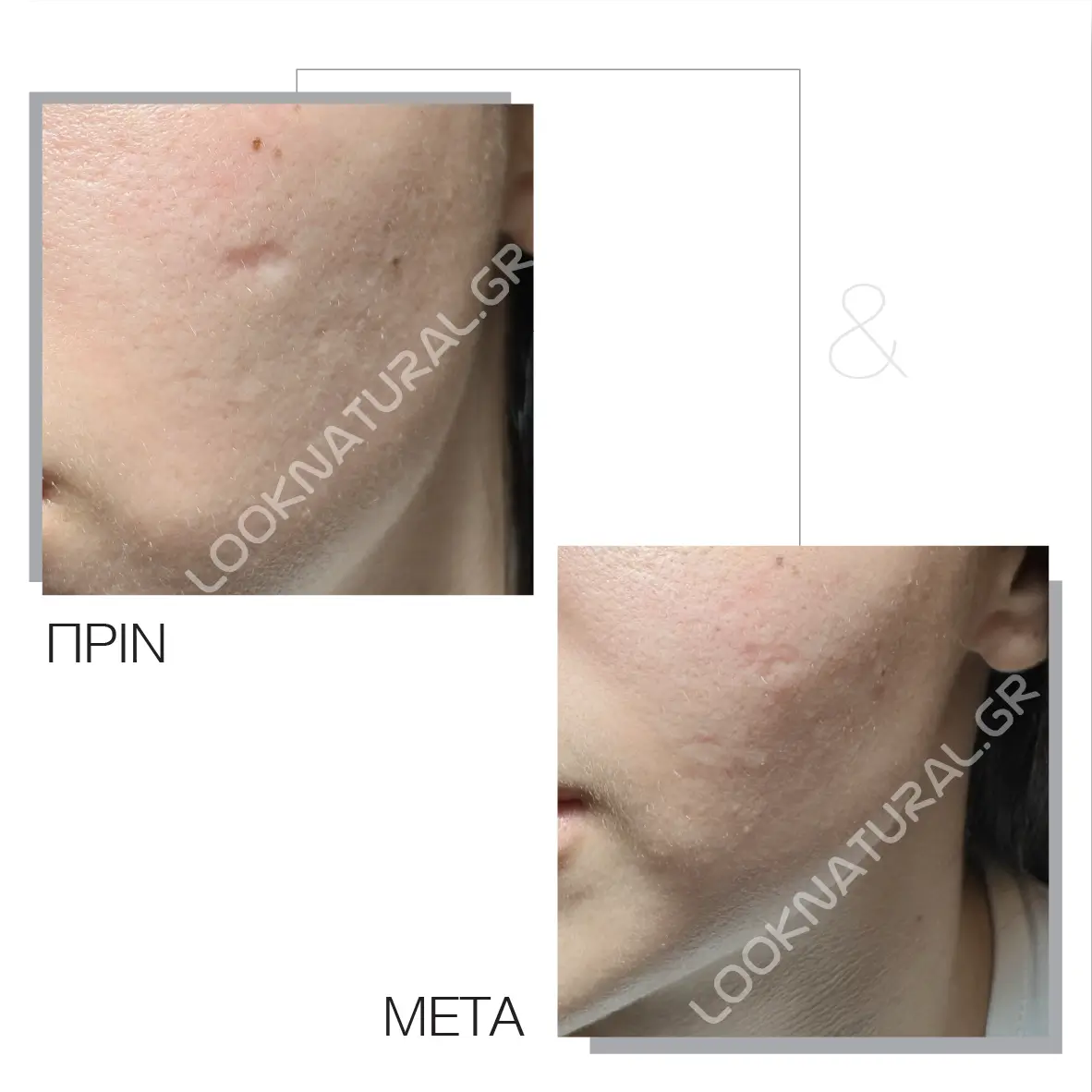 Πριν & Μετά - Ουλές Ακμής