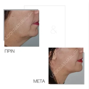 Πριν & Μετά - Facelift