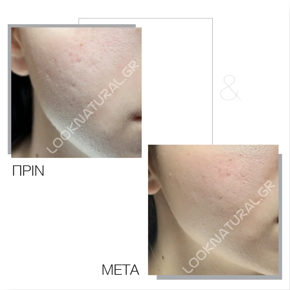 Πριν & Μετά - Ουλές Ακμής