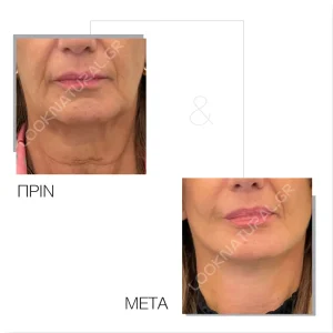 Πριν & Μετά - Facelift