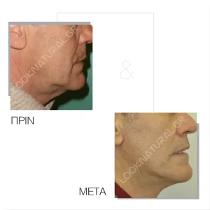 Πριν & Μετά - Facelift