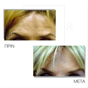 Πριν & Μετά - Βουτουλινική Τοξίνη