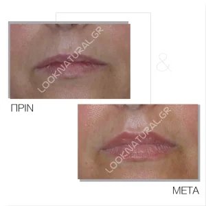 Πριν & Μετά - Αυξητική Χειλιών