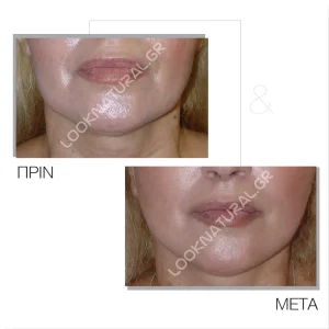 Πριν & Μετά - Facelift