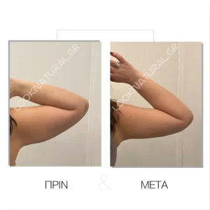 Πριν & Μετά - Βραχιονοπλαστική