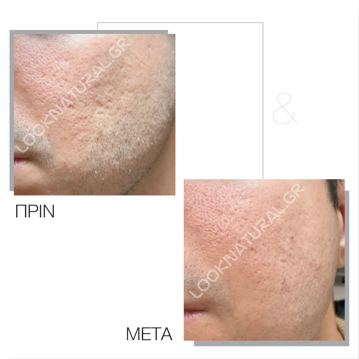 Πριν & Μετά - Ουλές Ακμής