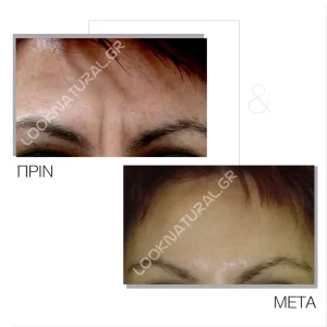 Πριν & Μετά - Βουτουλινική Τοξίνη