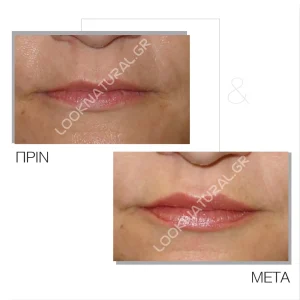 Πριν & Μετά - Αυξητική Χειλιών