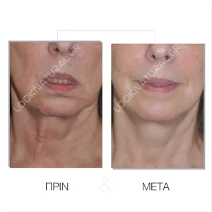 Πριν & Μετά - Facelift