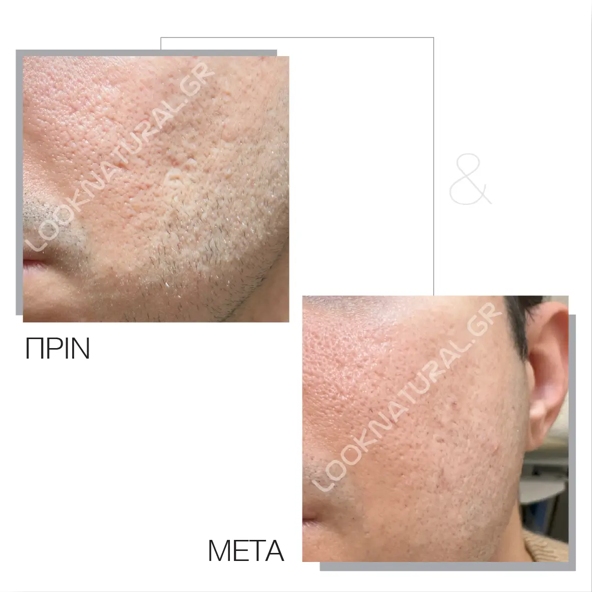 Πριν & Μετά - Ουλές Ακμής