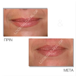 Πριν & Μετά - Αυξητική Χειλιών