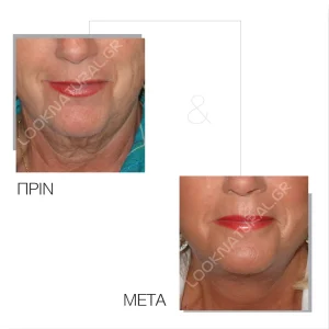 Πριν & Μετά - Facelift