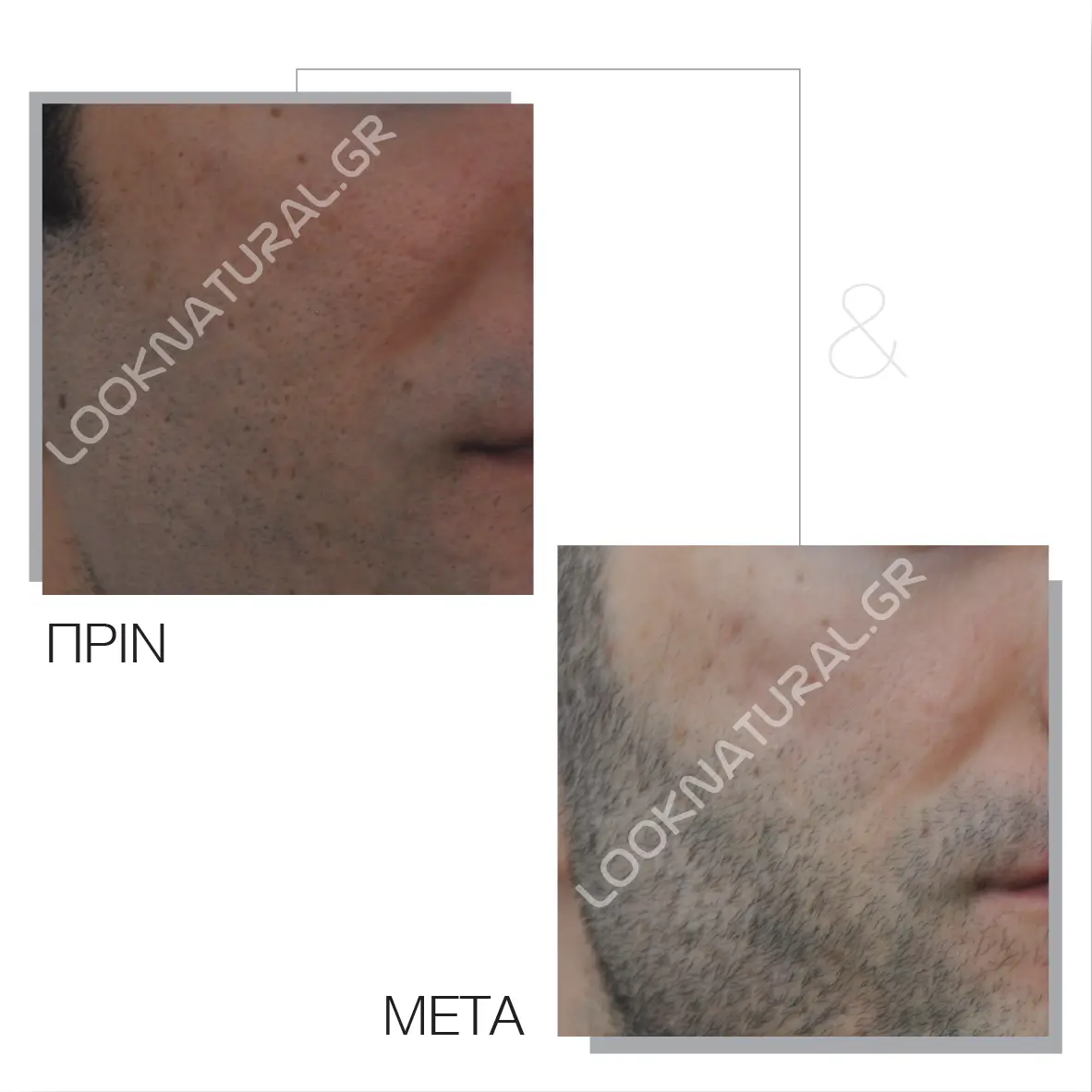 Πριν & Μετά - Ουλές Ακμής