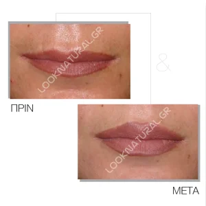 Πριν & Μετά - Αυξητική Χειλιών