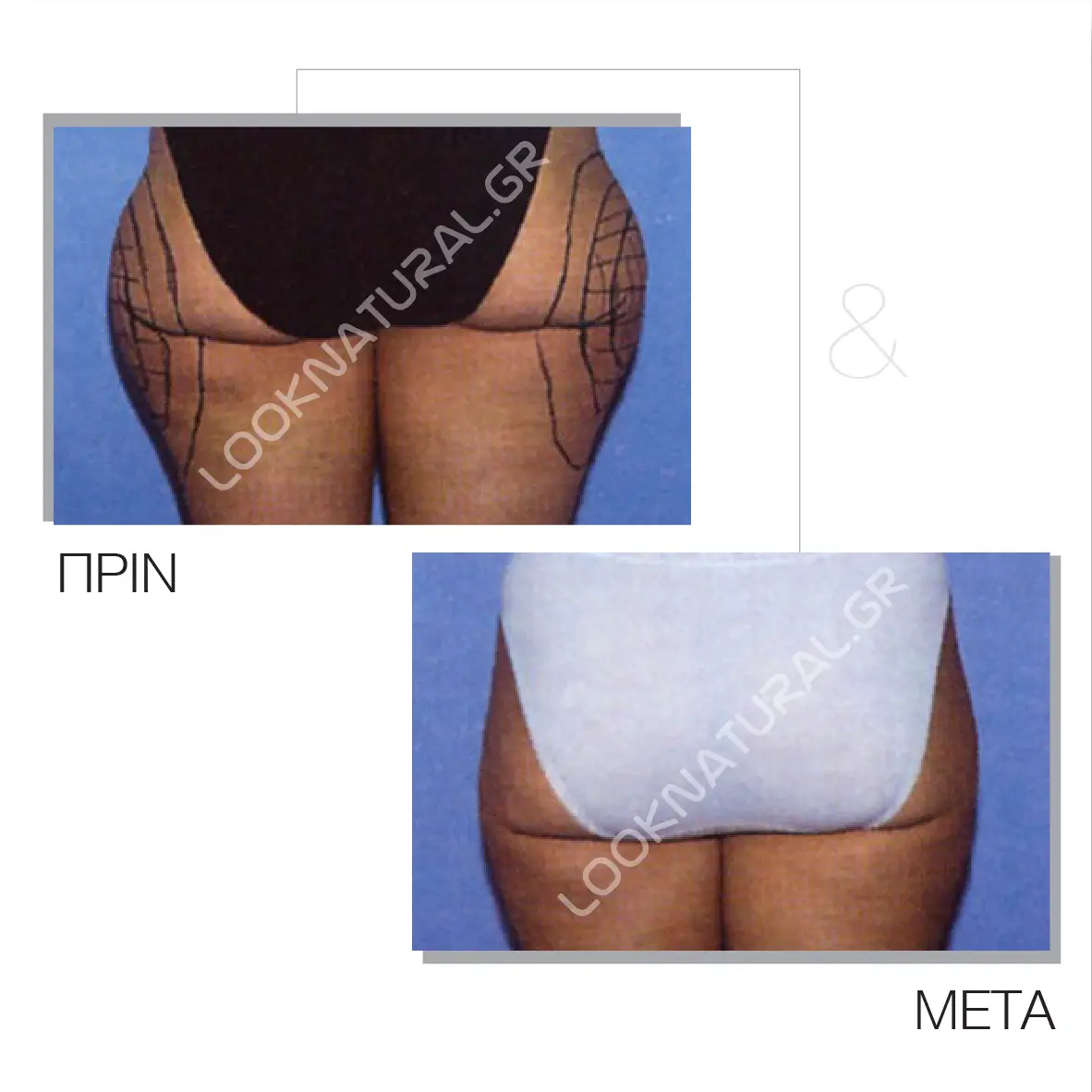 Πριν & Μετά - Λιποαναρρόφηση