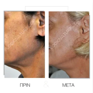 Πριν & Μετά - Facelift