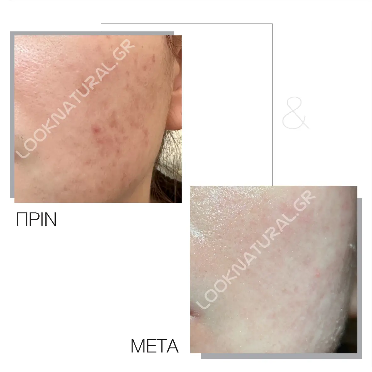 Πριν & Μετά - Ουλές Ακμής