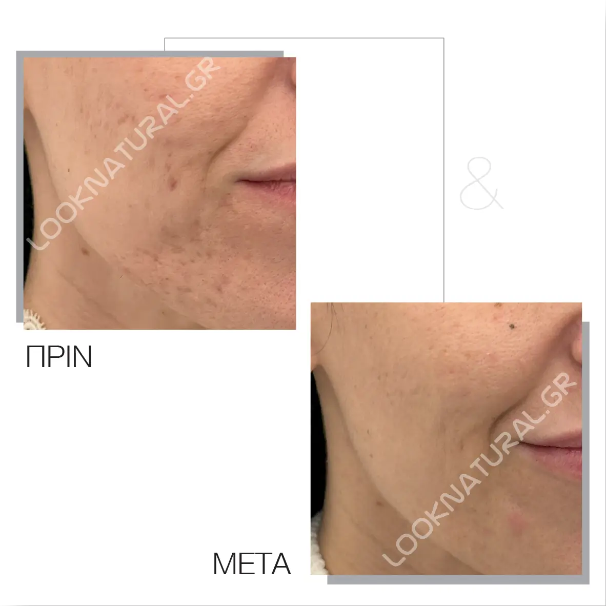 Πριν & Μετά - Ουλές Ακμής