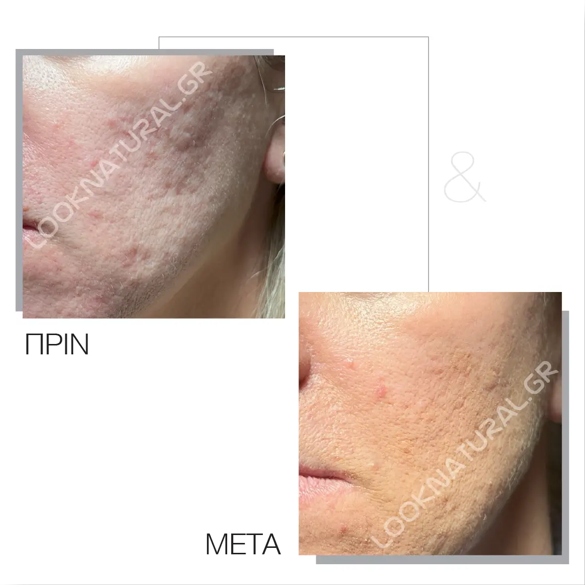 Πριν & Μετά - Ουλές Ακμής