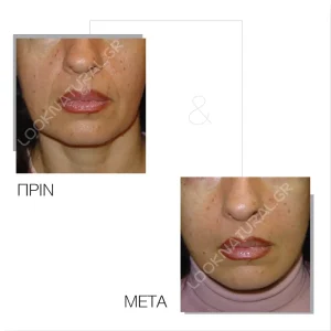 Πριν & Μετά - Facelift