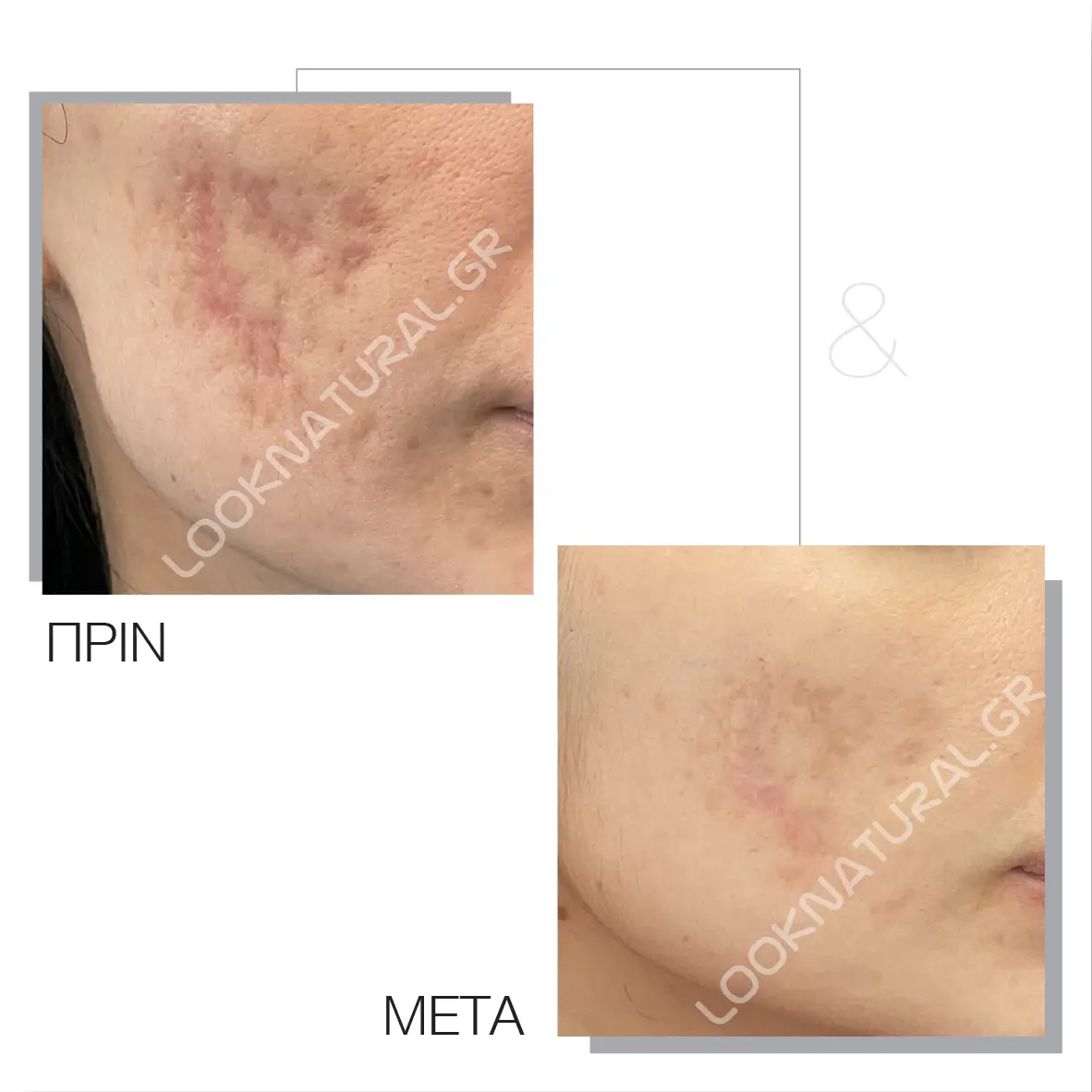 Πριν & Μετά - Ουλές Ακμής