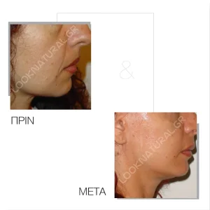 Πριν & Μετά - Facelift