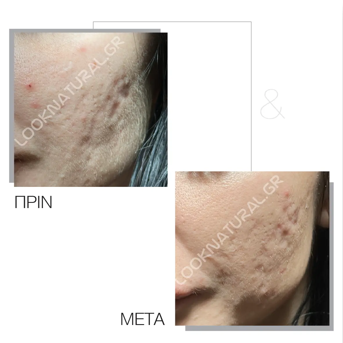 Πριν & Μετά - Ουλές Ακμής